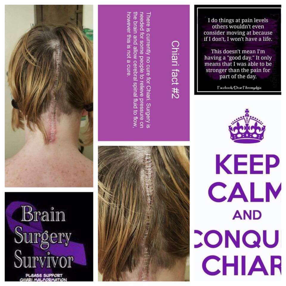 Chiari warrior 2 time brain surgery survivor