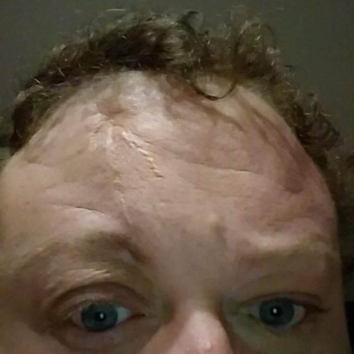 My Life as a Brain Injured American